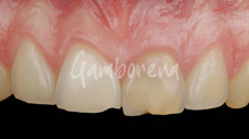 odontología estética Clínica dental gamborena Donostia