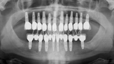 Implantes múltiples Dr. Gamborena Donostia San Sebastian