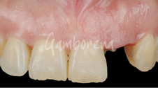 Implantes dentales Dr Gamborena Donostia San Sebastián