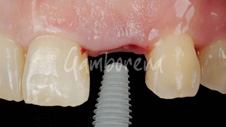 Implantes dentales Dr. Gamborena Donostia San Sebastián