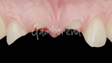 Implantes dentales Dr. Gamborena Donostia San Sebastián
