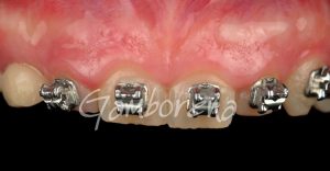 Periodoncia alargamiento coronario Clínica Dental Dr. Gamborena