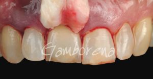 Periodoncia Injerto en implantes Clínica Dental Dr. Gamborena