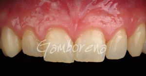Periodoncia alargamiento coronario Clínica Dental Dr. Gamborena