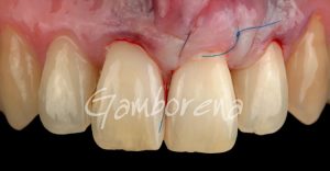 Periodoncia Tratamientos Clínica  Dental Dr. Gamborena