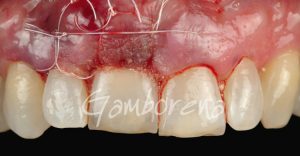 Periodoncia Injerto en implantes Clínica Dental Dr. Gamborena
