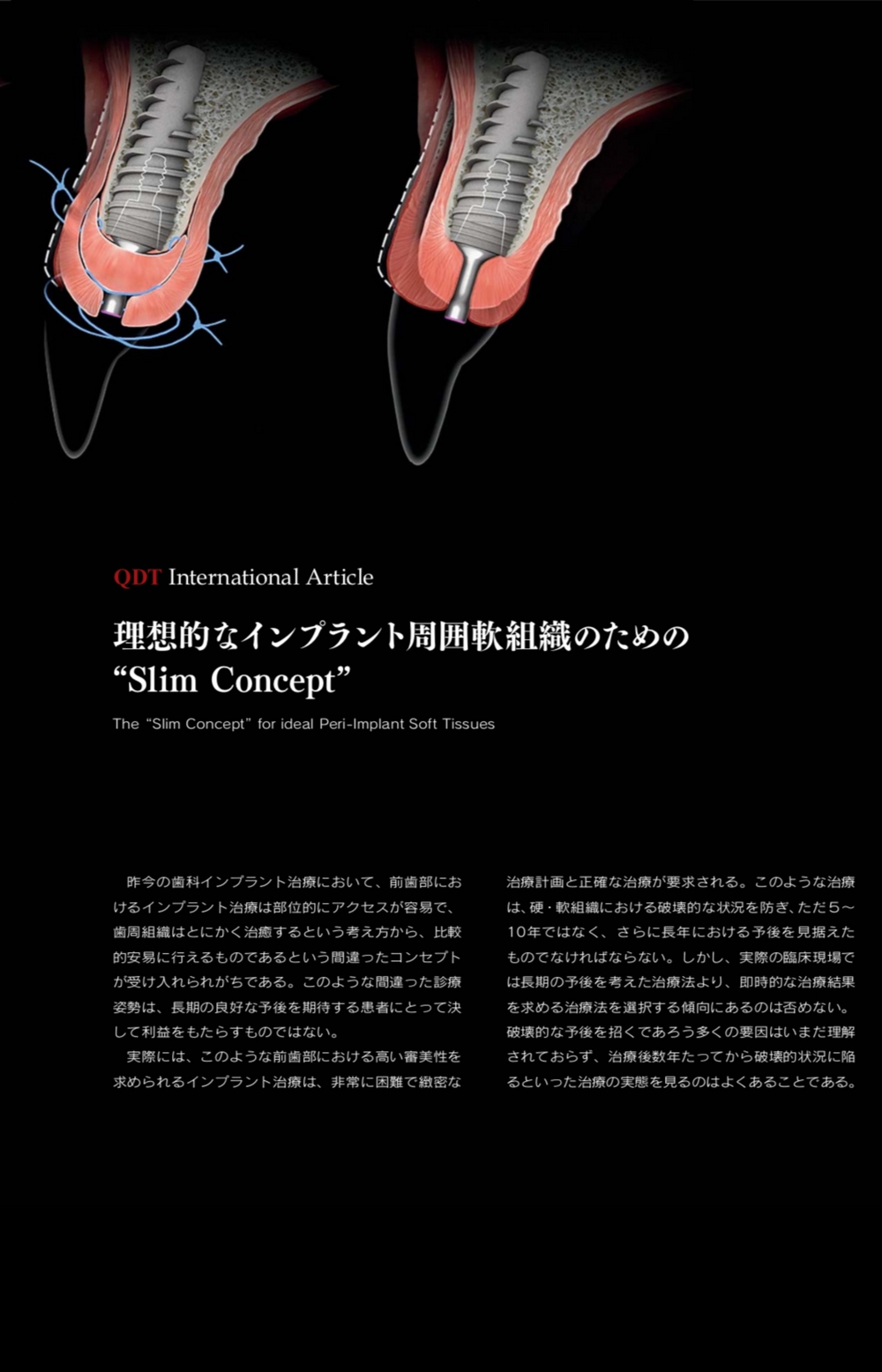 2018 3月海外論文ゲラ180119 The “Slim Concept” for Ideal Peri-Implant Soft Tissues Japones 1